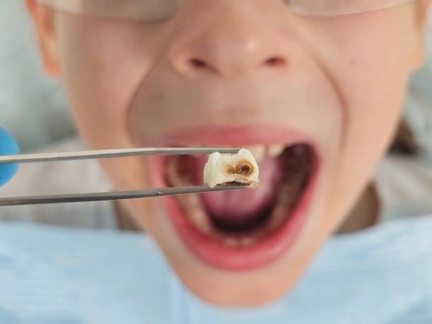 Best Broken Tooth Emergency  in Yakima, WA